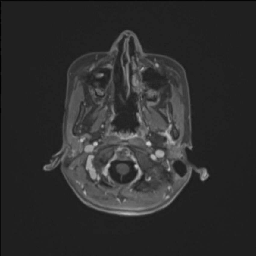 Brainstem glioma (Radiopaedia 70548-80674 Axial T1 C+ 18).jpg
