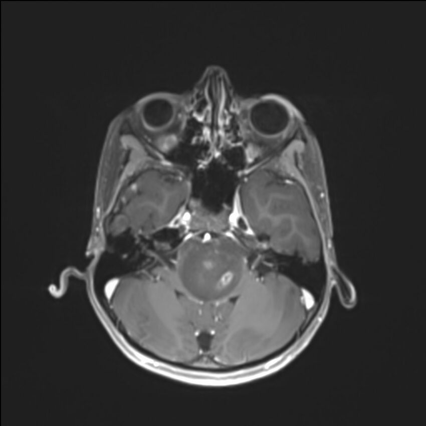 Brainstem glioma (Radiopaedia 70548-80674 Axial T1 C+ 43).jpg