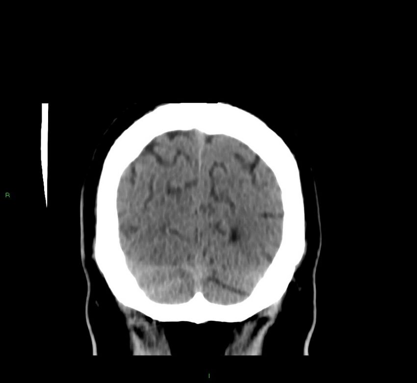 Brainstem hemorrhage (Radiopaedia 58794-66028 Coronal non-contrast 12).jpg
