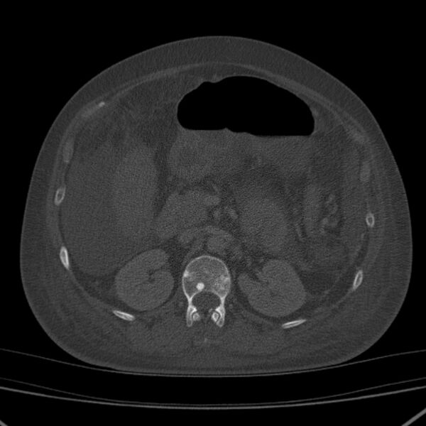 File:Breast cancer metastases - hepatic and skeletal (Radiopaedia 34201-35461 Axial bone window 53).jpg