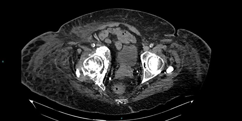 File:Breast cancer pelvic bony metastases (Radiopaedia 84470-99824 Axial bone window 55).jpg