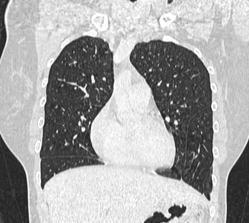 Bronchial atresia (Radiopaedia 50007-55297 Coronal lung window 30).jpg