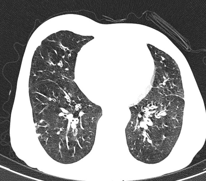 File:Bronchiolitis (Radiopaedia 24616-24887 Axial lung window 38).jpg