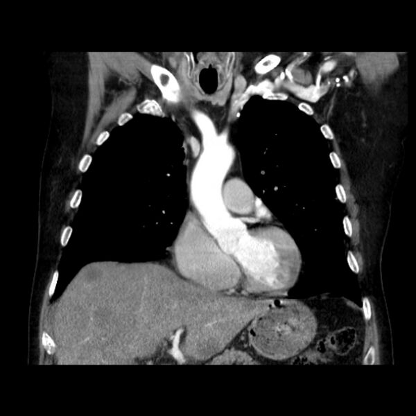 File:Bronchogenic adenocarcinoma and pulmonary embolism (Radiopaedia 9097-9806 C 18).jpg