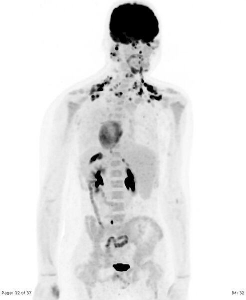 File:Brown fat uptake (FDG PET-CT) (Radiopaedia 77392-89513 MIP 31).jpg