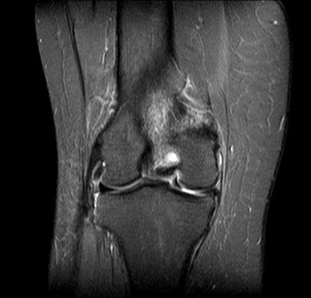 File:Bucket handle tear - medial meniscus (Radiopaedia 24900-25163 Coronal T2 fat sat 3).png