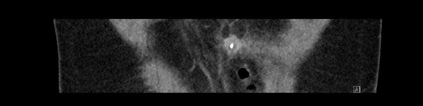 Buried bumper syndrome - gastrostomy tube (Radiopaedia 63843-72575 Coronal Inject 22).jpg