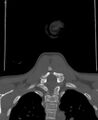 Butterfly vertebra (Radiopaedia 77903-90209 Coronal bone window 66).jpg