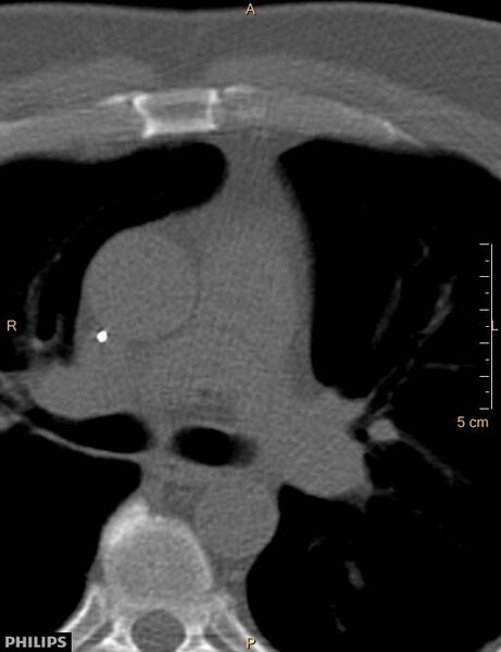 File:Calcified cardiac fibroma (Radiopaedia 39267-41519 Axial bone window 7).jpg