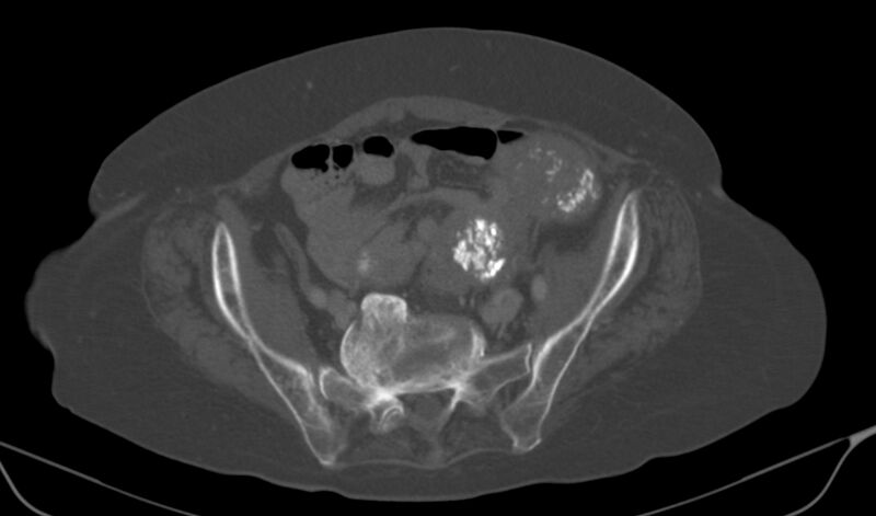 File:Calcified fibroids (Radiopaedia 20306-20228 Axial bone window 12).jpg