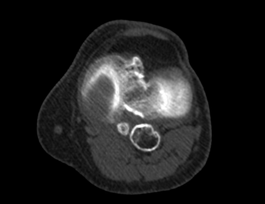 Calcified hematoma - popliteal fossa (Radiopaedia 63938-72763 Axial bone window 30).jpg