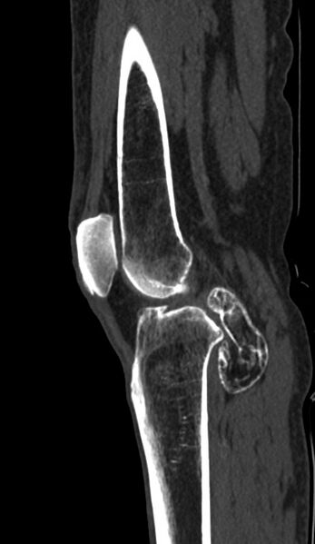 File:Calcified hematoma - popliteal fossa (Radiopaedia 63938-72763 Sagittal bone window 49).jpg