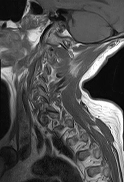 File:Calcified meningioma - cervical canal (Radiopaedia 70136-82468 Sagittal T1 12).jpg