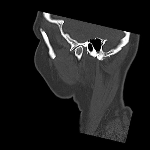 File:Canal up mastoidectomy (Radiopaedia 78108-90638 Sagittal bone window 10).jpg