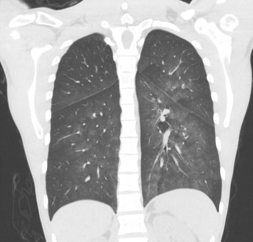 Cannabis-induced diffuse alveolar hemorrhage (Radiopaedia 89834-106946 Coronal lung window 28).jpg