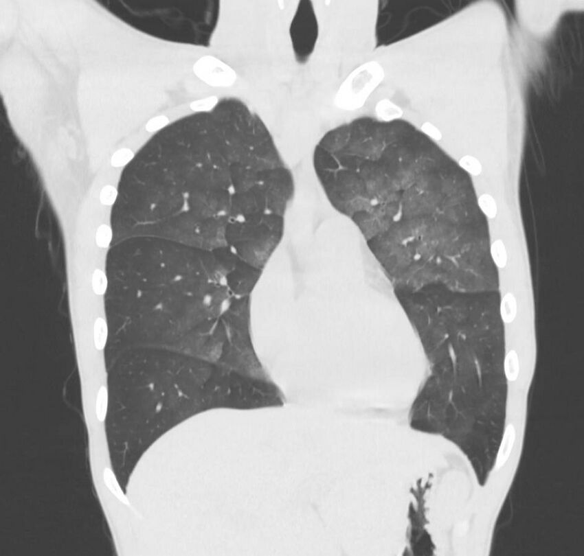 Cannabis-induced diffuse alveolar hemorrhage (Radiopaedia 89834-106946 Coronal lung window 62).jpg