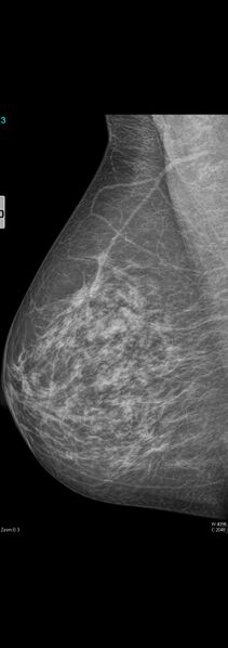 File:Carcinoma of left breast (Radiopaedia 28504-28746 MLO 1).jpg