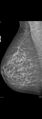 Carcinoma of left breast (Radiopaedia 28504-28746 MLO 1).jpg