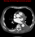 Cardiac perforation following transcatheter aortic valve implantation (Radiopaedia 23714-23863 A 1).png