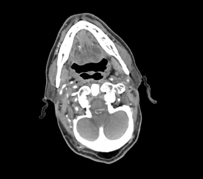 File:Carotid artery pseudoaneurysm (Radiopaedia 84030-99259 C 23).jpg