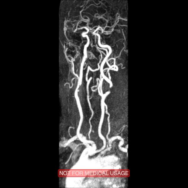 File:Carotid artery stenosis (Radiopaedia 28786-29087 3D MRA 12).jpg