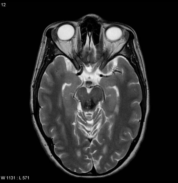 File:Cavernous malformation of the midbrain (Radiopaedia 7791-8615 Axial T2 1).jpg
