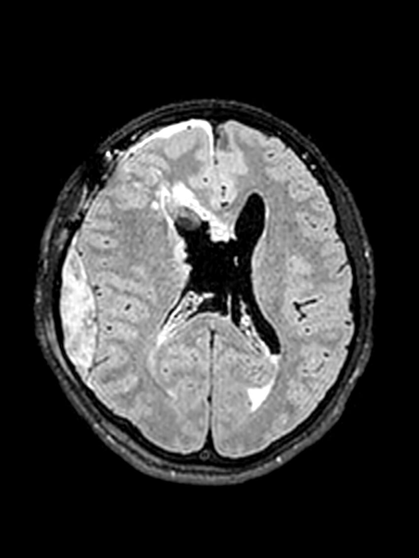 Central neurocytoma (Radiopaedia 79320-92381 Axial FLAIR 76).jpg