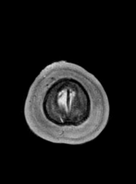 File:Central neurocytoma (Radiopaedia 79320-92381 Axial T1 45).jpg