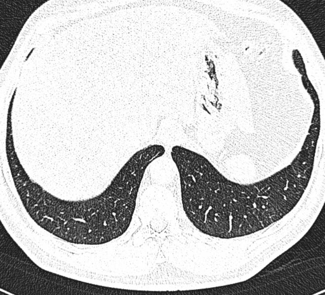 File:Centrilobular pulmonary emphysema (Radiopaedia 26808-26971 Axial lung window 34).jpg