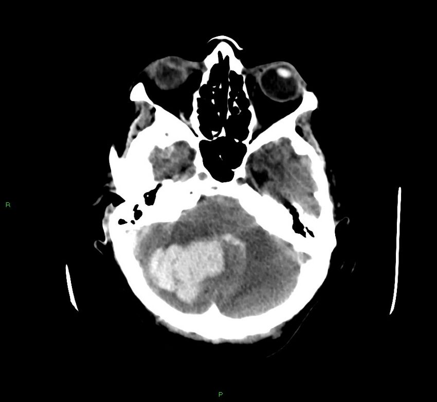 Cerebellar hemorrhage (Radiopaedia 58792-66026 Axial non-contrast 39).jpg