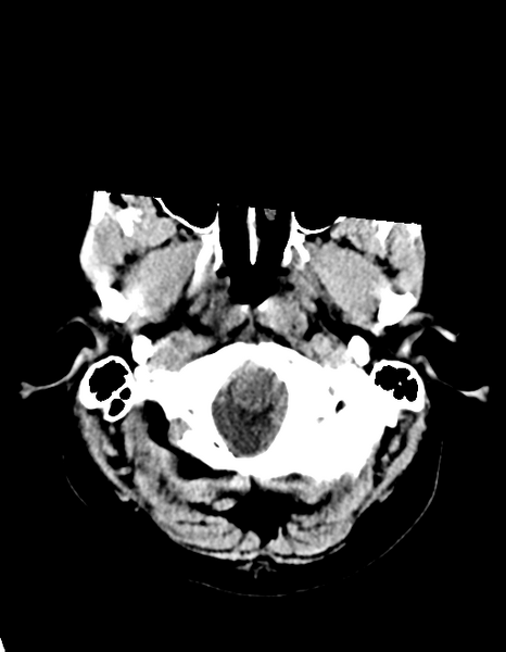 File:Cerebellar infarct due to vertebral artery dissection with posterior fossa decompression (Radiopaedia 82779-97030 Axial non-contrast 5).png
