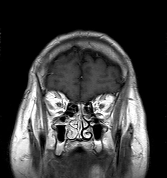 File:Cerebellopontine angle meningioma (Radiopaedia 24459-24764 Coronal T1 C+ 2).jpg