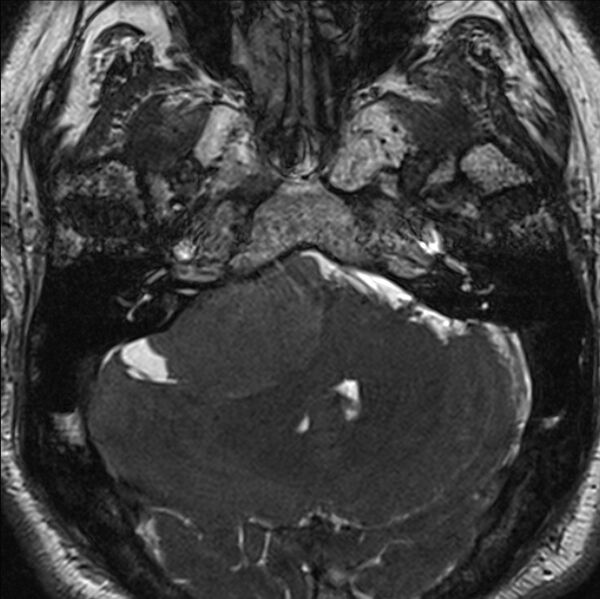 File:Cerebellopontine angle meningioma (Radiopaedia 24459-24764 I 19).jpg