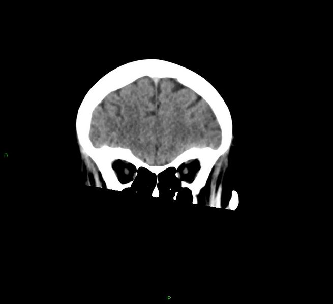 File:Cerebral amyloid angiopathy-associated lobar intracerebral hemorrhage (Radiopaedia 58378-65516 Coronal non-contrast 48).jpg