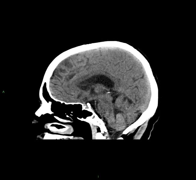 File:Cerebral amyloid angiopathy-associated lobar intracerebral hemorrhage (Radiopaedia 58529-65681 B 23).jpg