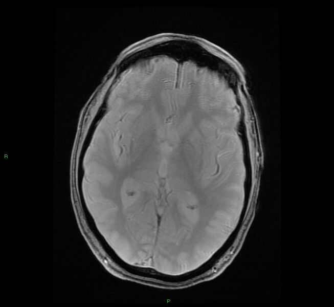 File:Cerebral amyloid angiopathy-associated lobar intracerebral hemorrhage (Radiopaedia 58529-65684 Axial Gradient Echo 13).jpg