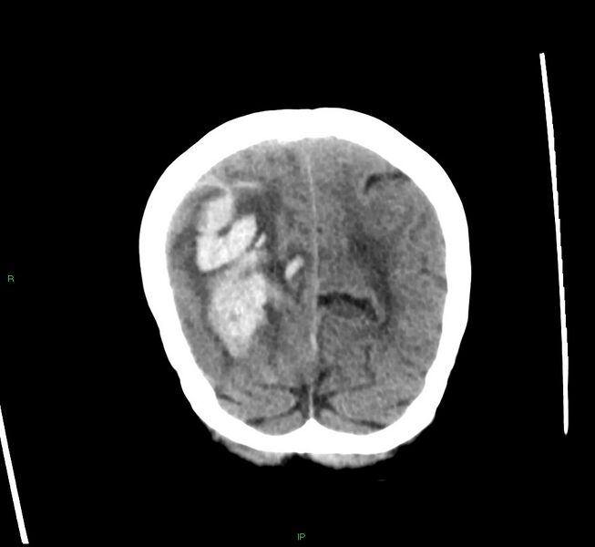 File:Cerebral amyloid angiopathy-associated lobar intracerebral hemorrhage (Radiopaedia 58563-65727 Coronal non-contrast 16).jpg