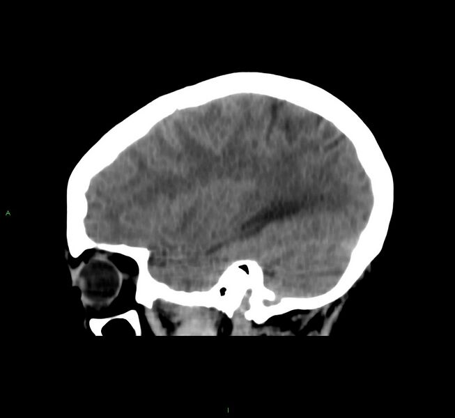 File:Cerebral amyloid angiopathy-associated lobar intracerebral hemorrhage (Radiopaedia 58566-65730 C 37).jpg