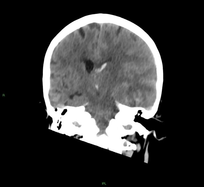 File:Cerebral amyloid angiopathy-associated lobar intracerebral hemorrhage (Radiopaedia 58754-65975 Coronal non-contrast 32).jpg