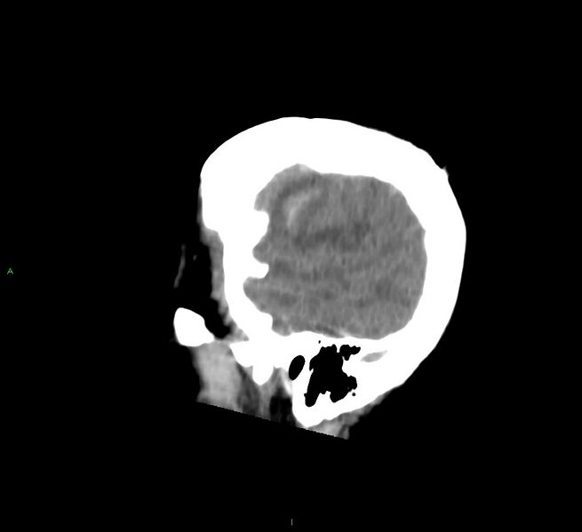File:Cerebral amyloid angiopathy-associated lobar intracerebral hemorrhage (Radiopaedia 58756-65977 C 10).jpg