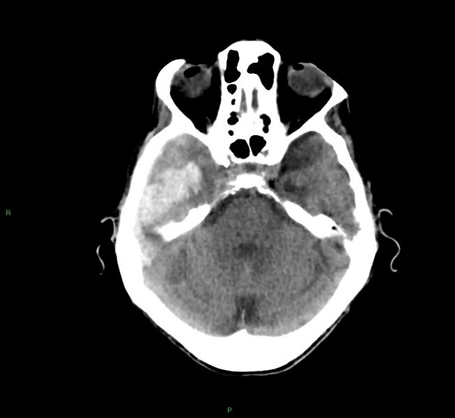 File:Cerebral amyloid angiopathy-associated lobar intracerebral hemorrhage (Radiopaedia 58758-65980 Axial non-contrast 35).jpg