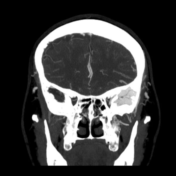 File:Cerebral arteriovenous malformation (Radiopaedia 43729-47189 C 13).jpg