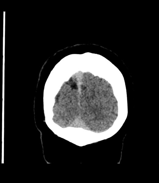 File:Cerebral dural venous sinus thrombosis (Radiopaedia 86514-102575 Coronal non-contrast 51).jpg