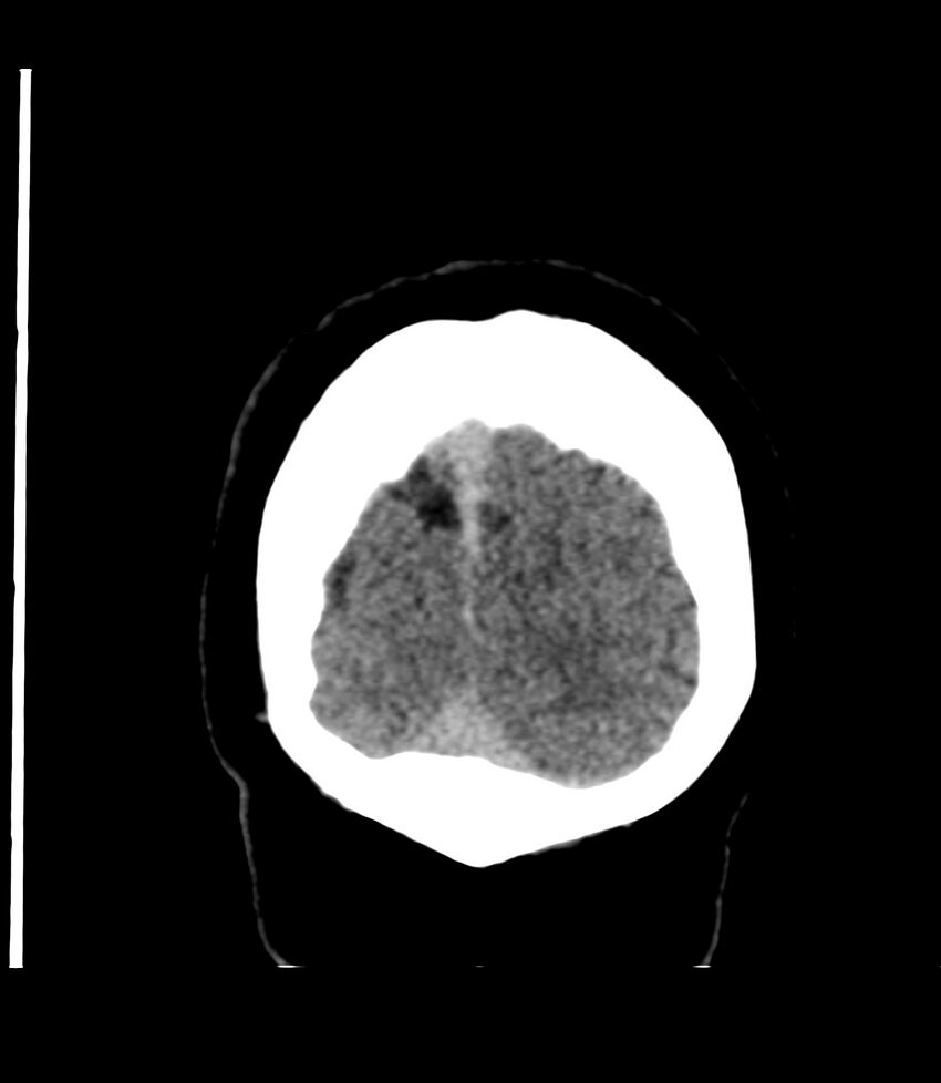 Cerebral dural venous sinus thrombosis (Radiopaedia 86514-102575 Coronal non-contrast 51).jpg