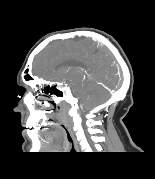 File:Cerebral dural venous sinus thrombosis (Radiopaedia 86514-102576 C 23).jpg