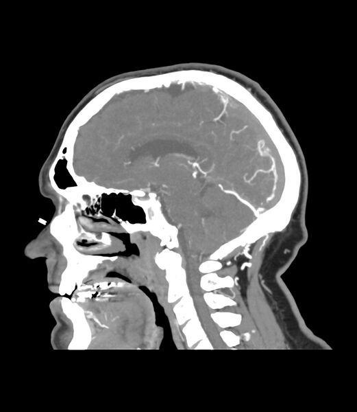 File:Cerebral dural venous sinus thrombosis (Radiopaedia 86514-102576 C 24).jpg