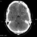 Cerebral hemorrhagic contusion with subdural and subarachnoid hemorrhage (Radiopaedia 10680-11146 Axial non-contrast 8).jpg
