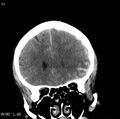 Cerebral hemorrhagic contusion with subdural and subarachnoid hemorrhage (Radiopaedia 10680-11146 Coronal non-contrast 6).jpg