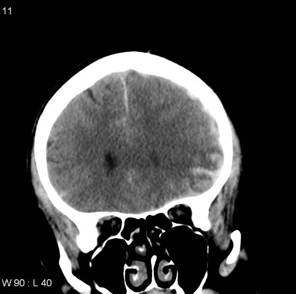 File:Cerebral hemorrhagic contusion with subdural and subarachnoid hemorrhage (Radiopaedia 10680-11146 Coronal non-contrast 6).jpg