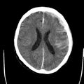 Cerebral hemorrhagic contusions (Radiopaedia 23145-23188 Axial non-contrast 24).jpg